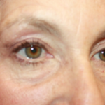 Blepharoplasty and Brow Lift Before & After Patient #20322