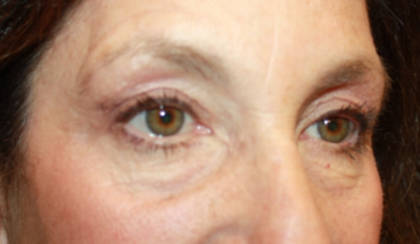 Blepharoplasty and Brow Lift Before & After Patient #20322