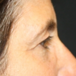 Blepharoplasty and Brow Lift Before & After Patient #20322