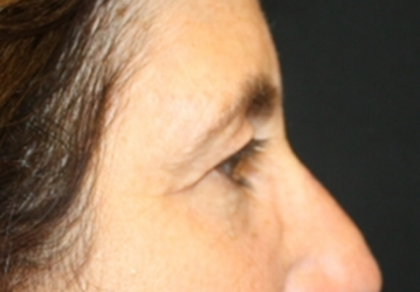 Blepharoplasty and Brow Lift Before & After Patient #20322