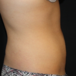 Liposuction Before & After Patient #21403