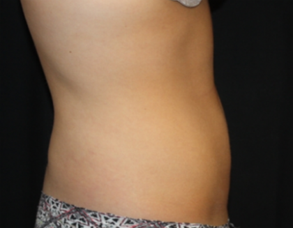 Liposuction Before & After Patient #21403