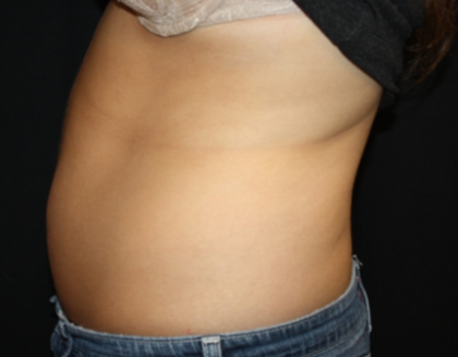 Liposuction Before & After Patient #21403