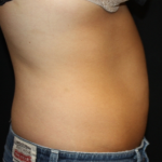 Liposuction Before & After Patient #21403