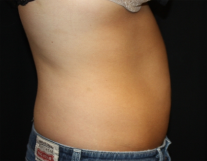 Liposuction Before & After Patient #21403