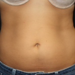 Liposuction Before & After Patient #21403