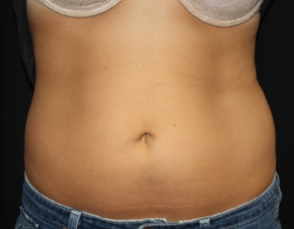 Liposuction Before & After Patient #21403