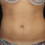 Liposuction Before & After Patient #21403