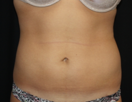 Liposuction Before & After Patient #21403