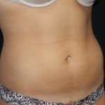 Liposuction Before & After Patient #21403