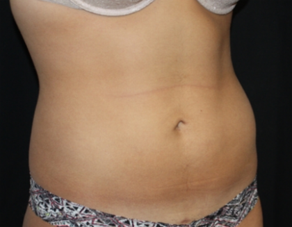 Liposuction Before & After Patient #21403