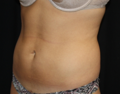 Liposuction Before & After Patient #21403