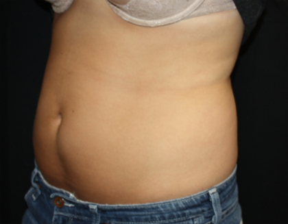 Liposuction Before & After Patient #21403