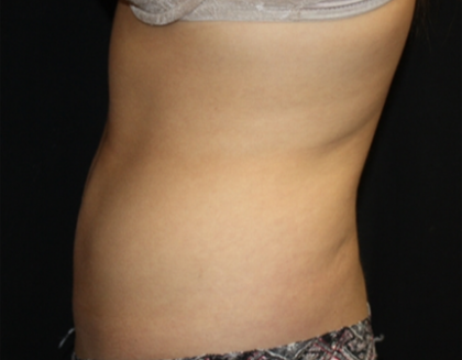 Liposuction Before & After Patient #21403