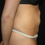 Tummy Tuck Before & After Patient #22847