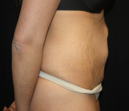 Tummy Tuck Before & After Patient #22847