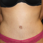 Tummy Tuck Before & After Patient #22847