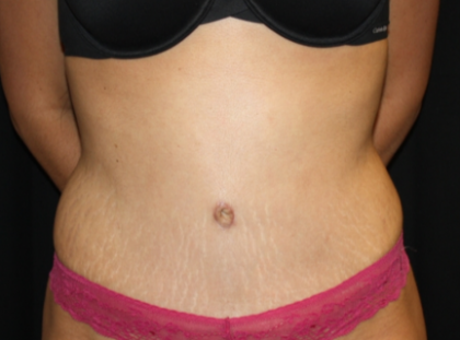 Tummy Tuck Before & After Patient #22847