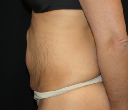 Tummy Tuck Before & After Patient #22847