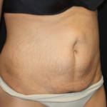 Tummy Tuck Before & After Patient #22847