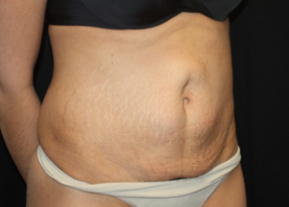 Tummy Tuck Before & After Patient #22847