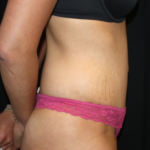 Tummy Tuck Before & After Patient #22847