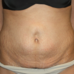 Tummy Tuck Before & After Patient #22847