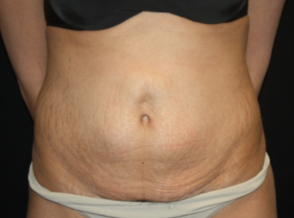 Tummy Tuck Before & After Patient #22847