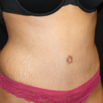 Tummy Tuck Before & After Patient #22847