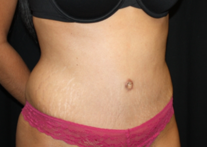 Tummy Tuck Before & After Patient #22847