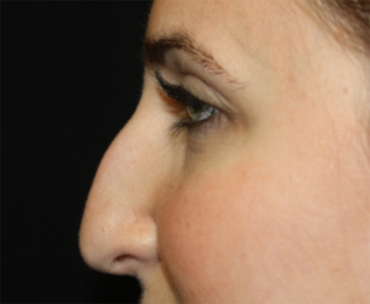 Rhinoplasty Before & After Patient #21684