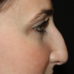 Rhinoplasty Before & After Patient #21684
