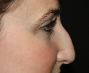 Rhinoplasty Before & After Patient #21684