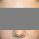 Otoplasty Before & After Patient #21459