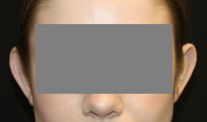 Otoplasty Before & After Patient #21459