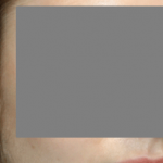 Otoplasty Before & After Patient #21459