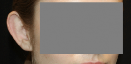 Otoplasty Before & After Patient #21459