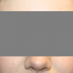 Otoplasty Before & After Patient #21459