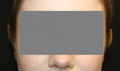 Otoplasty Before & After Patient #21459