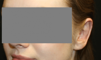 Otoplasty Before & After Patient #21459