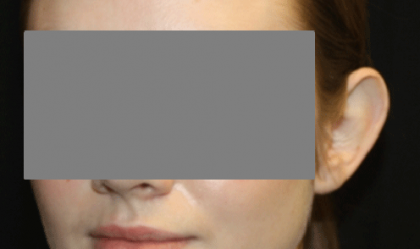 Otoplasty Before & After Patient #21459