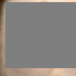 Otoplasty Before & After Patient #21459