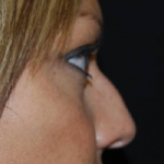 Rhinoplasty Before & After Patient #21693