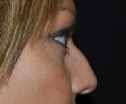 Rhinoplasty Before & After Patient #21693