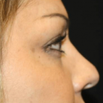 Rhinoplasty Before & After Patient #21693