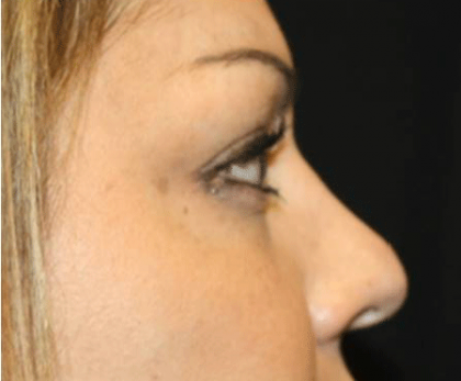 Rhinoplasty Before & After Patient #21693