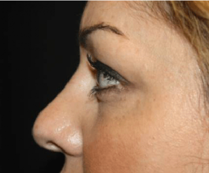 Rhinoplasty Before & After Patient #21693