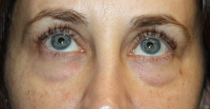Blepharoplasty Before & After Patient #24834