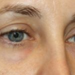 Blepharoplasty Before & After Patient #24834