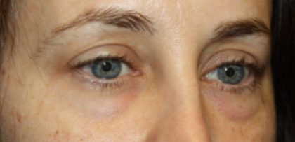 Blepharoplasty Before & After Patient #24834